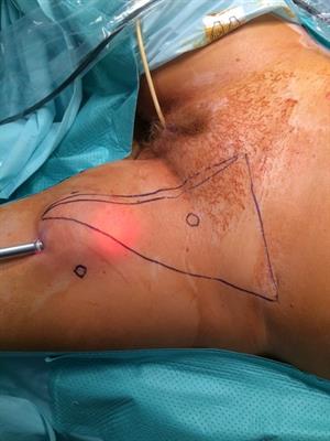 A single-center comparison of our initial experiences in treating penile and urethral cancer with video-endoscopic inguinal lymphadenectomy (VEIL) and later experiences in melanoma cases